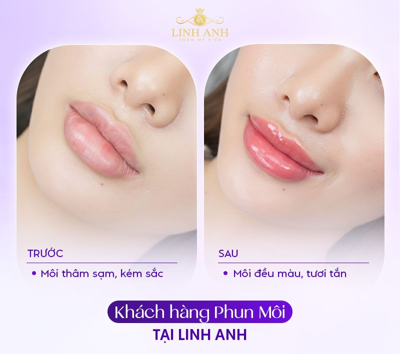 môi mới xăm bị nổi mụn nước khi nào thì khỏi môi mới xăm bị nổi mụn nước khi nào thì khỏi