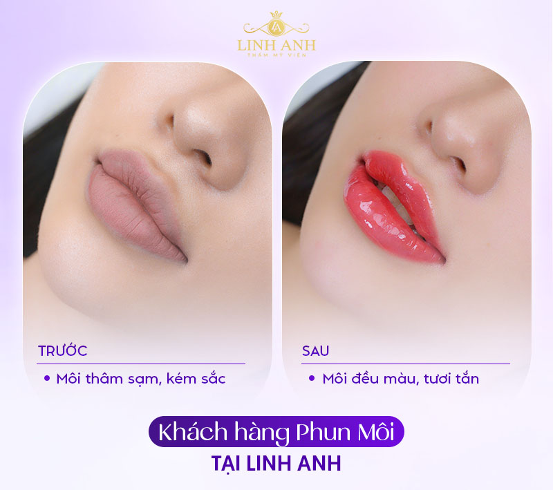 nổi mụn nước sau xăm môi khi nào thì hết nổi mụn nước sau xăm môi khi nào thì hết