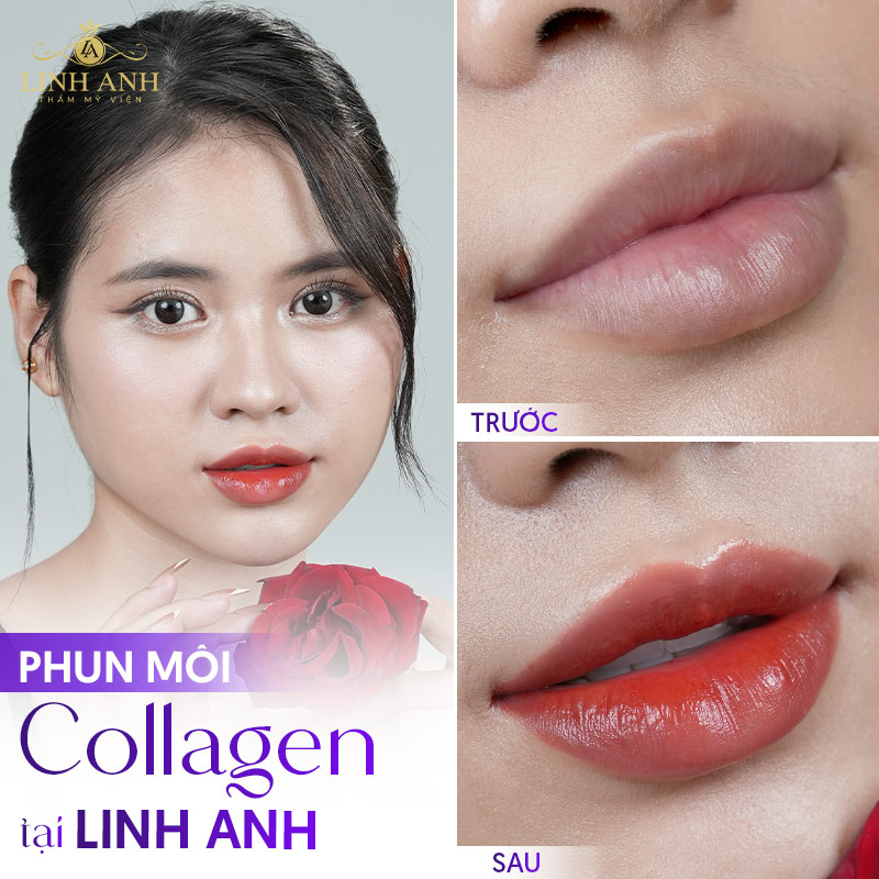 phun môi collagen là như thế nào phun môi collagen là như thế nào