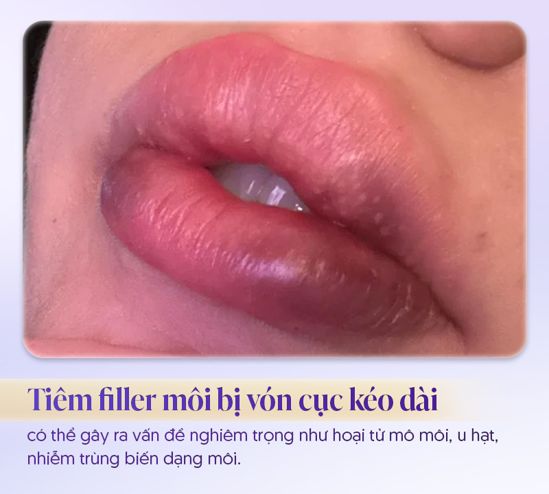 Tiêm filler môi bị vón cục có sao không