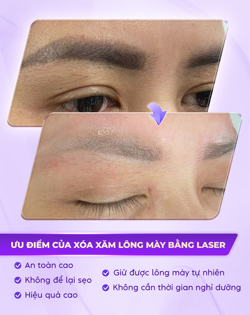 Ưu điểm của xóa xăm lông mày bằng laser