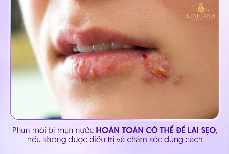 xăm môi bị mụn nước có gây sẹo không xăm môi bị mụn nước có gây sẹo không