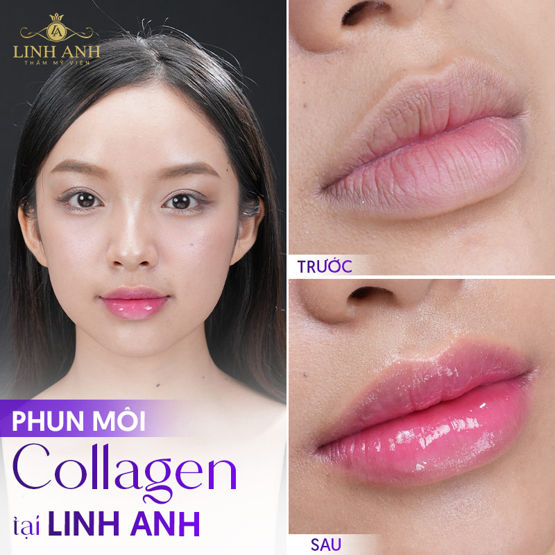 xăm môi collagen linh anh xăm môi collagen linh anh