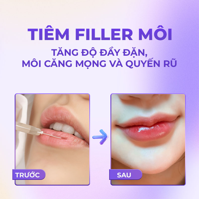 tiêm filler môi giá bao nhiêu tiêm filler môi giá bao nhiêu