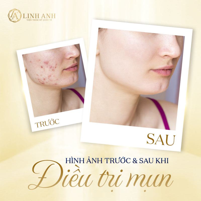 Cách Làm Xẹp Mụn Sưng Đỏ Không Nhân Cách Làm Xẹp Mụn Sưng Đỏ Không Nhân - Viện thẩm mỹ quốc tế Linh Anh