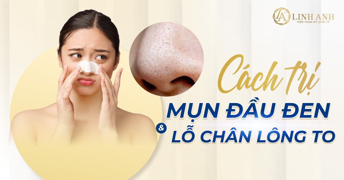 cách trị mụn đầu đen và lỗ chân lông to - Viện thẩm mỹ quốc tế Linh Anh