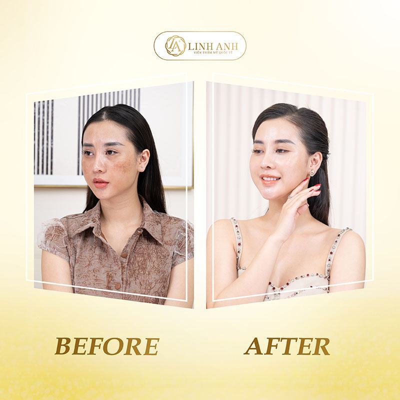Bị tàn nhang nên ăn gì uống gì Da bị tàn nhang nên ăn gì - Viện thẩm mỹ quốc tế Linh Anh