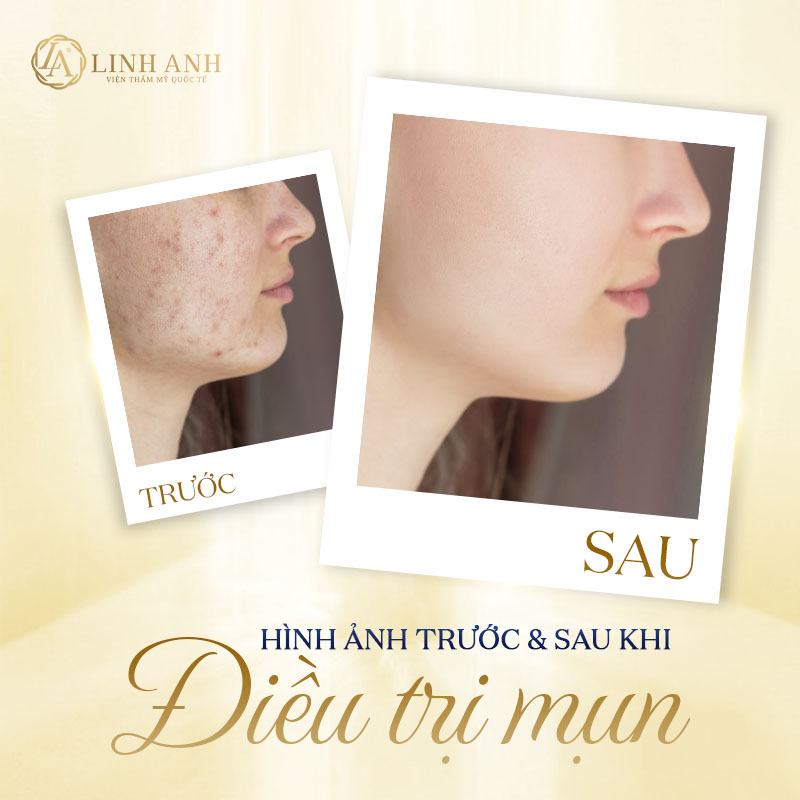 Giảm Mụn Sưng Đỏ Chỉ Sau 1 Đêm an toàn Giảm Mụn Sưng Đỏ Chỉ Sau 1 Đêm an toàn - Viện thẩm mỹ quốc tế Linh Anh