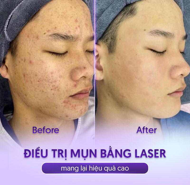 laser trị mụn giá bao nhiêu laser trị mụn giá bao nhiêu