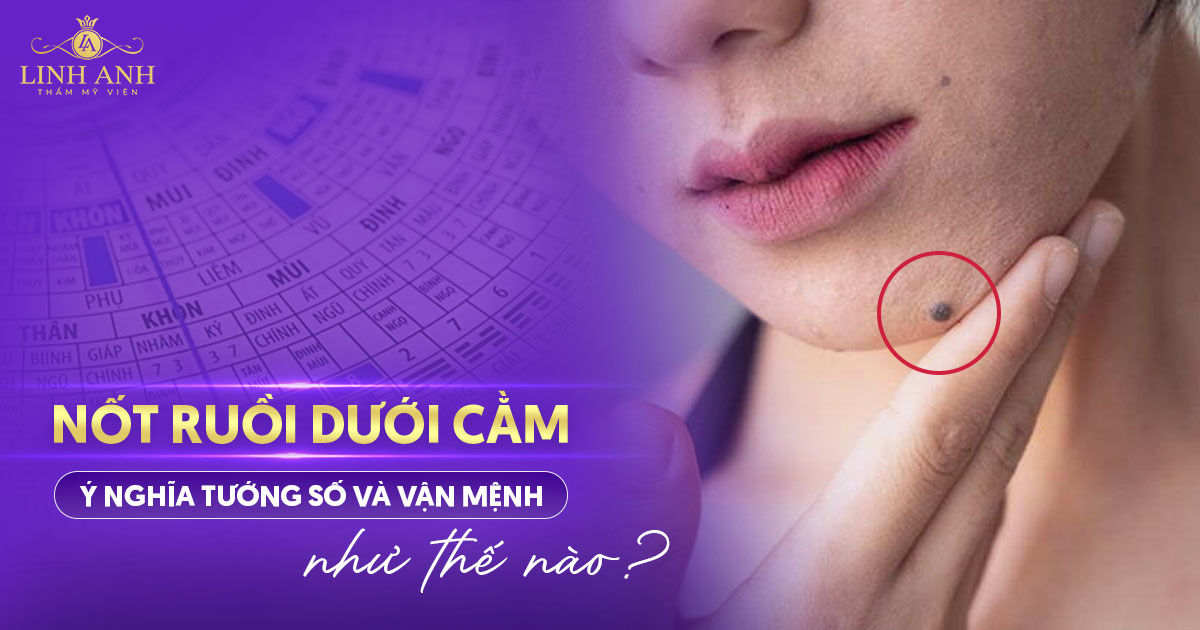Nốt ruồi dưới cằm