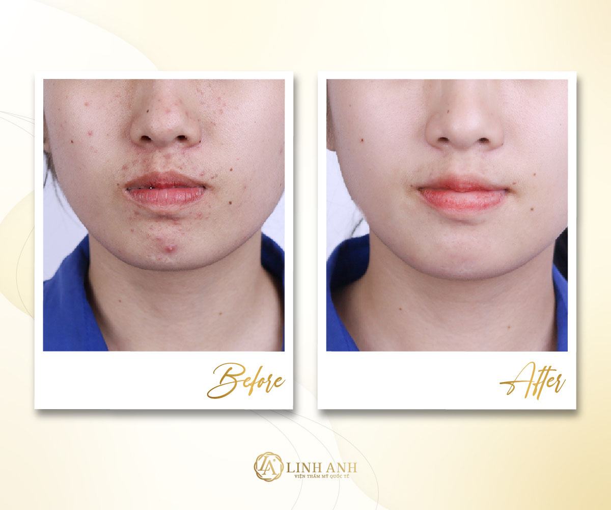 ăn mận có nổi mụn hay không ăn mận nhiều có bị nóng nổi mụn không - Viện thẩm mỹ quốc tế Linh Anh