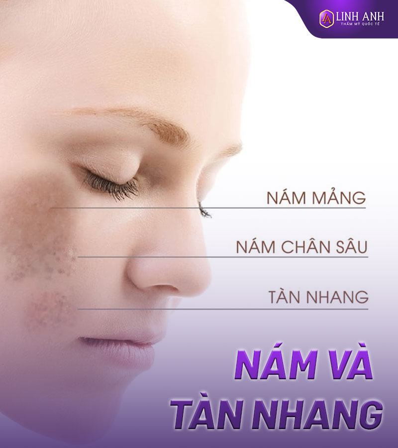 bài thuốc dân gian trị nám tàn nhang bài thuốc dân gian trị nám