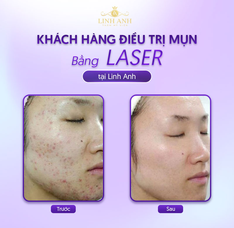 bắn laser trị mụn bắn laser trị mụn