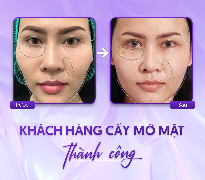 bang giá cấy mỡ mặt