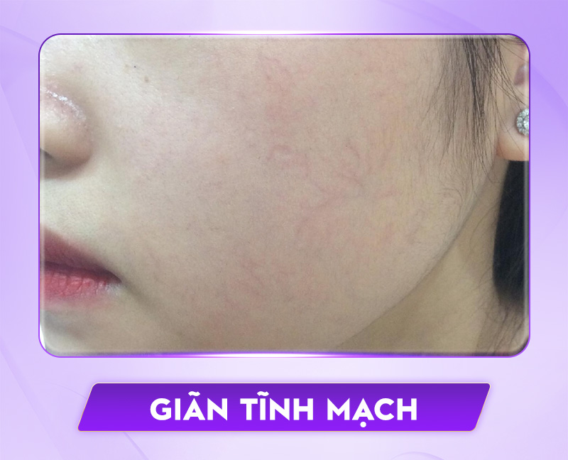bảng giá điều trị giãn mao mạch bảng giá điều trị giãn mao mạch