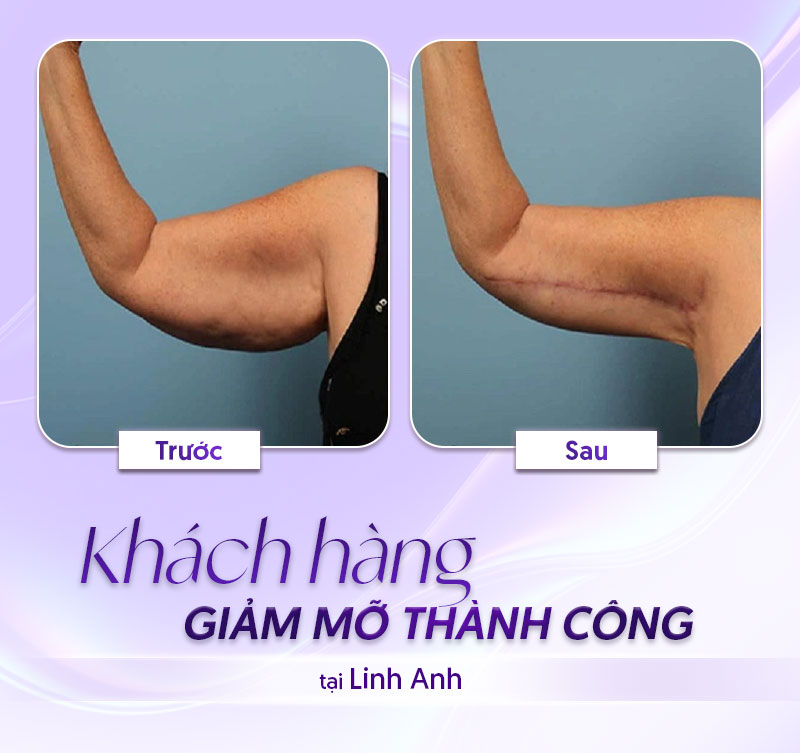 bảng giá hút mỡ bắp tay bảng giá hút mỡ bắp tay