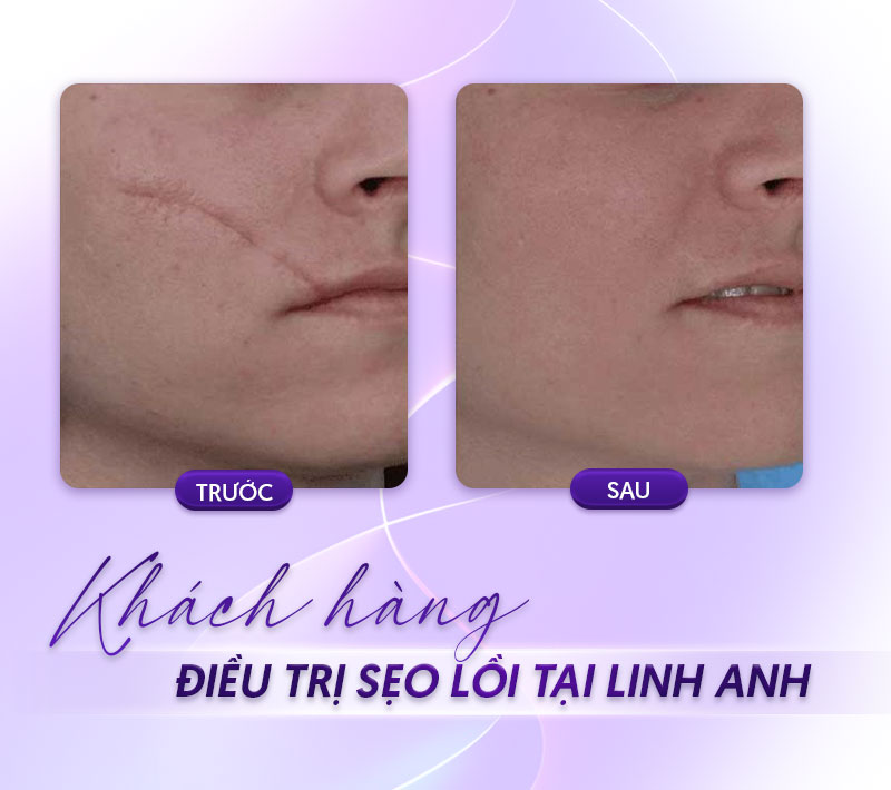 bảng giá trị sẹo lồi bệnh viện da liễu bảng giá trị sẹo lồi bệnh viện da liễu