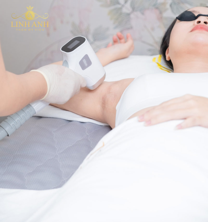 bị hôi nách sau khi triệt lông do đâu bị hôi nách sau khi triệt lông do đâu