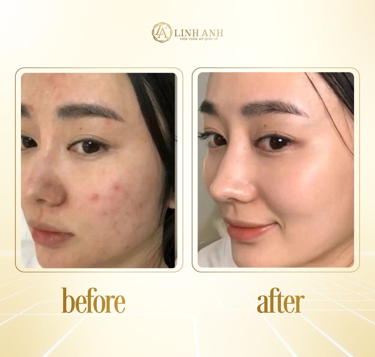 bị mụn có nên uống milo không bị mụn có nên uống milo không - Viện thẩm mỹ quốc tế Linh Anh