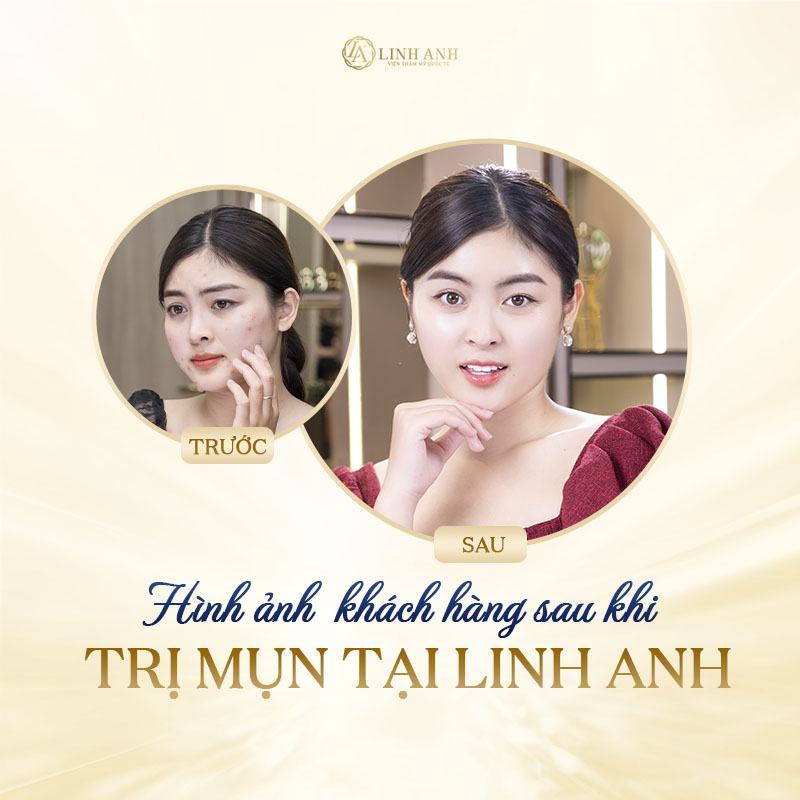 bị mụn khi mang thai là con trai hay gái - Viện thẩm mỹ quốc tế Linh Anh bị mụn khi mang thai là con trai hay gái - Viện thẩm mỹ quốc tế Linh Anh