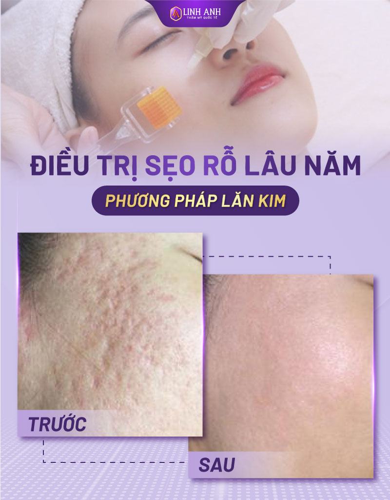 bị sẹo lồi kiêng ăn gì bị sẹo lõm kiêng ăn gì