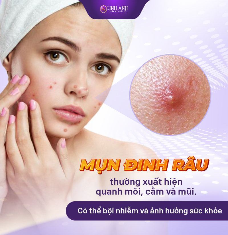 hình ảnh các loại mụn các loại mụn thường gặp