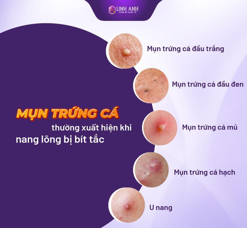 các loại mụn trên mặt các loại mụn trên mặt