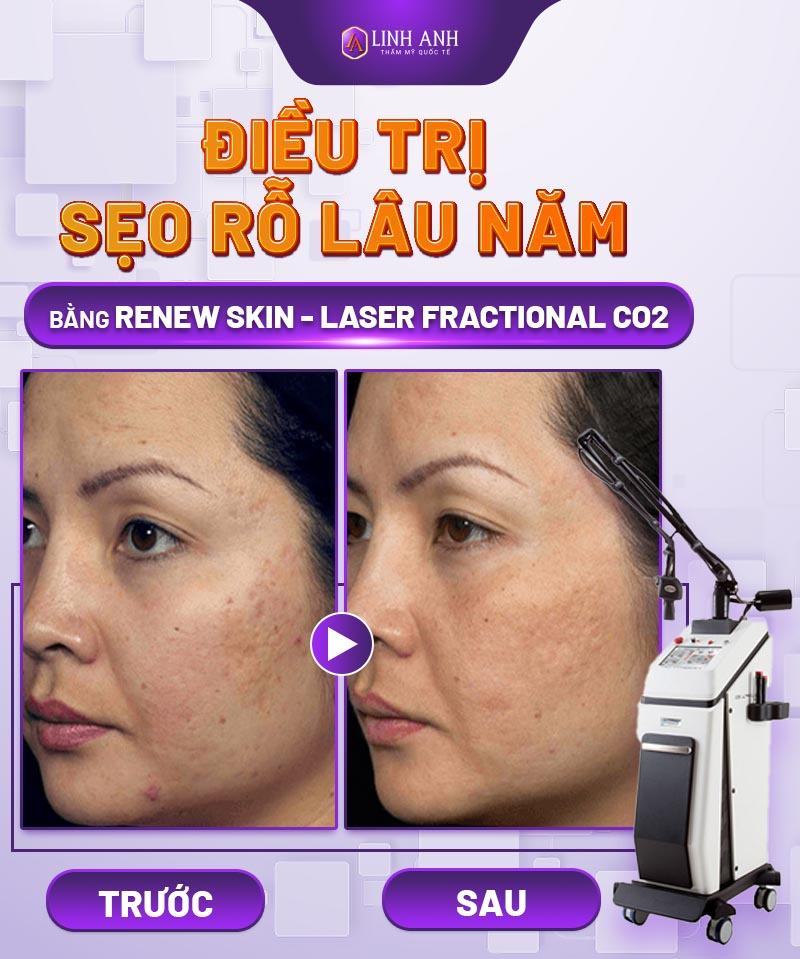 sẹo rỗ lâu năm có trị được không - Thẩm mỹ Quốc tế Linh Anh các phương pháp trị sẹo rỗ lâu năm hiệu quả nhất