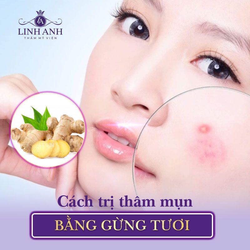 cách chữa trị thâm mụn tại nhà