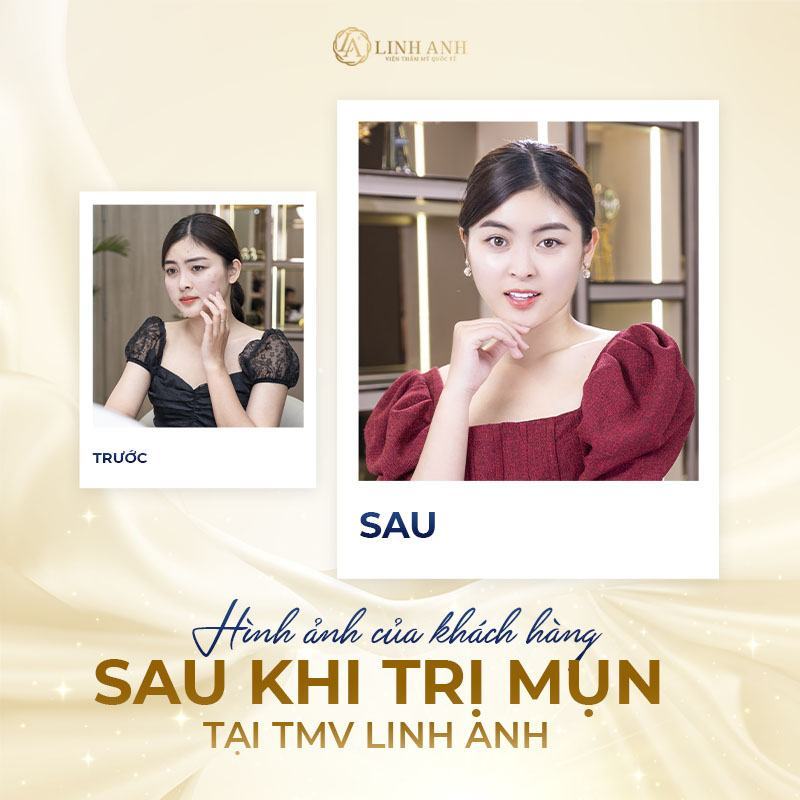 cách điều trị mụn liti trên mặt - Viện thẩm mỹ quốc tế Linh Anh cách điều trị mụn liti trên mặt - Viện thẩm mỹ quốc tế Linh Anh