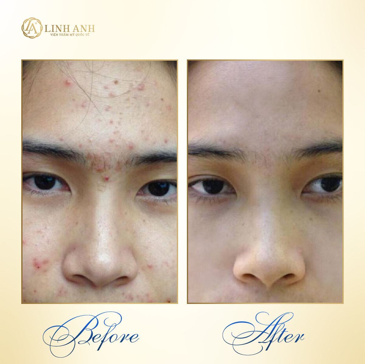 cách trị mụn thần tốc trong 1 ngày cách điều trị mụn tại nhà đơn giản - Viện thẩm mỹ quốc tế Linh Anh