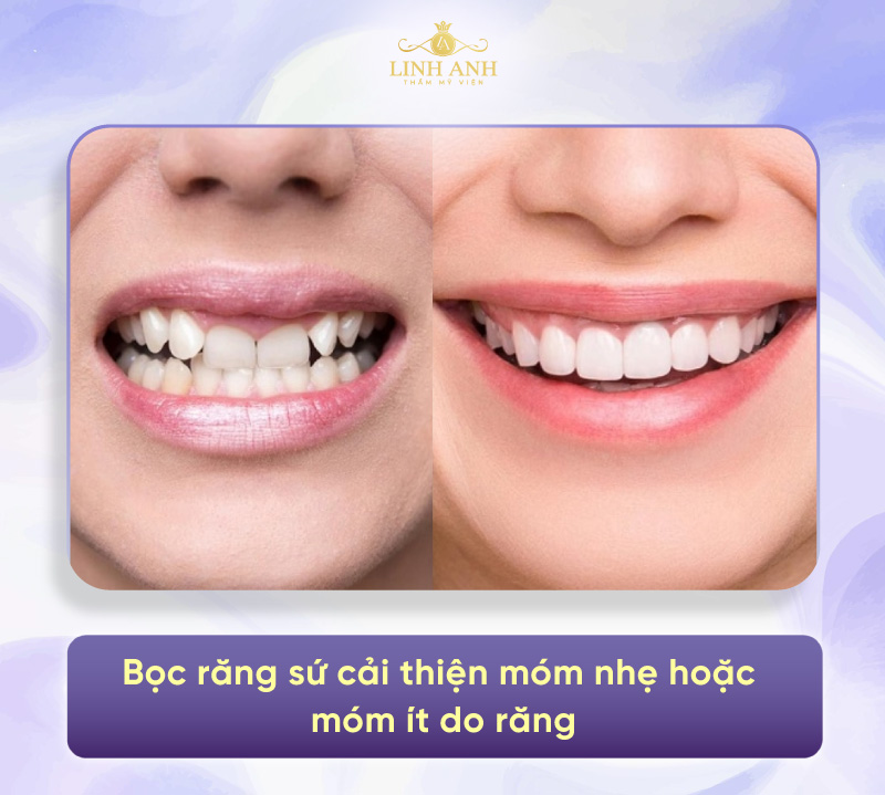cách khắc phục miệng móm