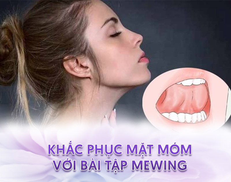 Cách khắc phục răng móm với bài tập Mewing.