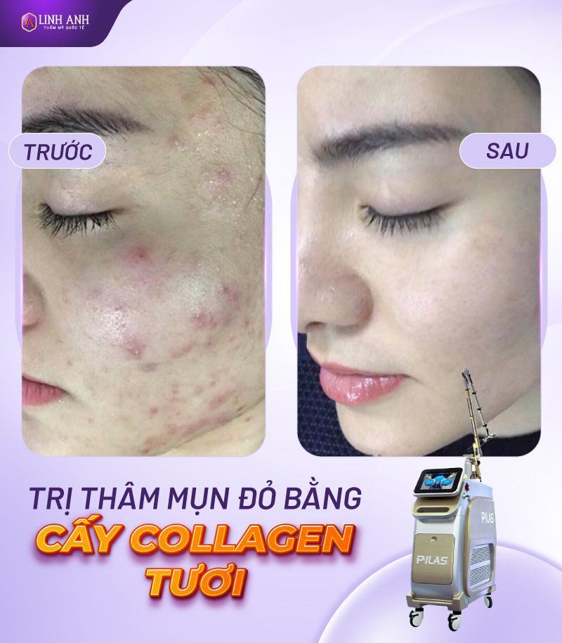 cách trị mụn thâm đỏ tại nhà cách làm mờ mụn thâm đỏ
