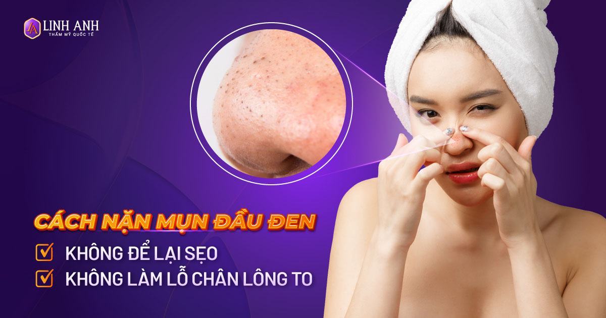 cách nặn mụn đầu đen