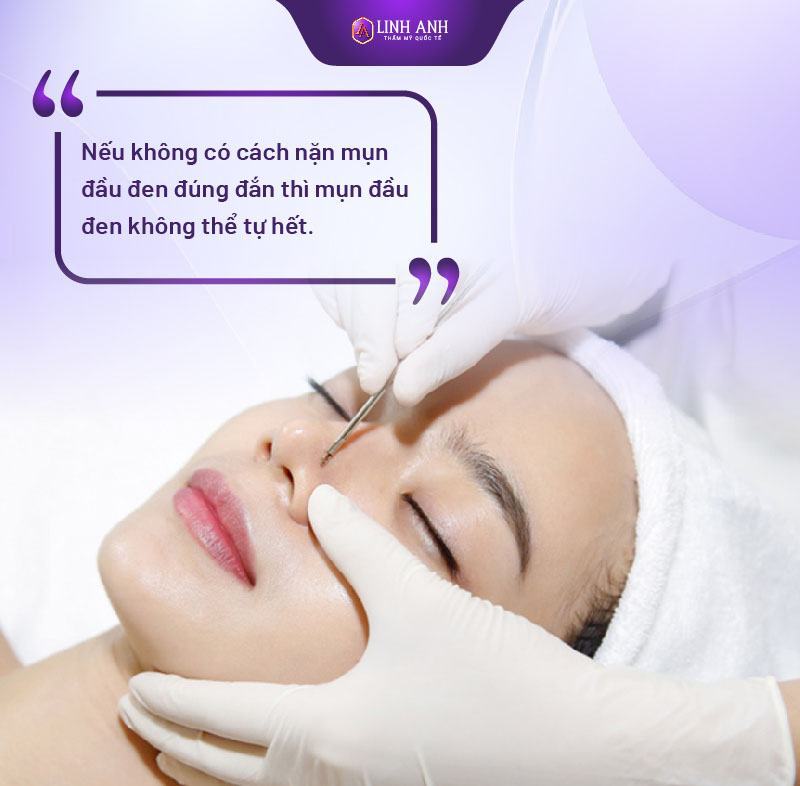 cách nặn mụn đầu đen trị mụn đầu đen ở mũi