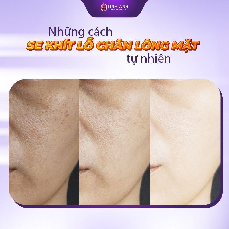 se khít lỗ chân lông cach se khit lo chan long