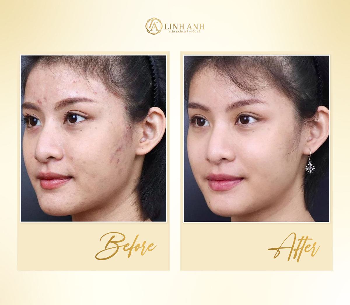 tinh trùng có trị mụn được không cách sử dụng tinh trùng trị mụn - Viện thẩm mỹ quốc tế Linh Anh