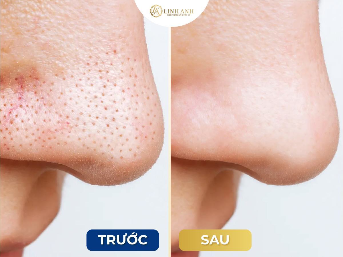 cách trị cho da mụn đầu đen và lỗ chân lông to - Viện thẩm mỹ quốc tế Linh Anh cách trị cho da mụn đầu đen và lỗ chân lông to - Viện thẩm mỹ quốc tế Linh Anh