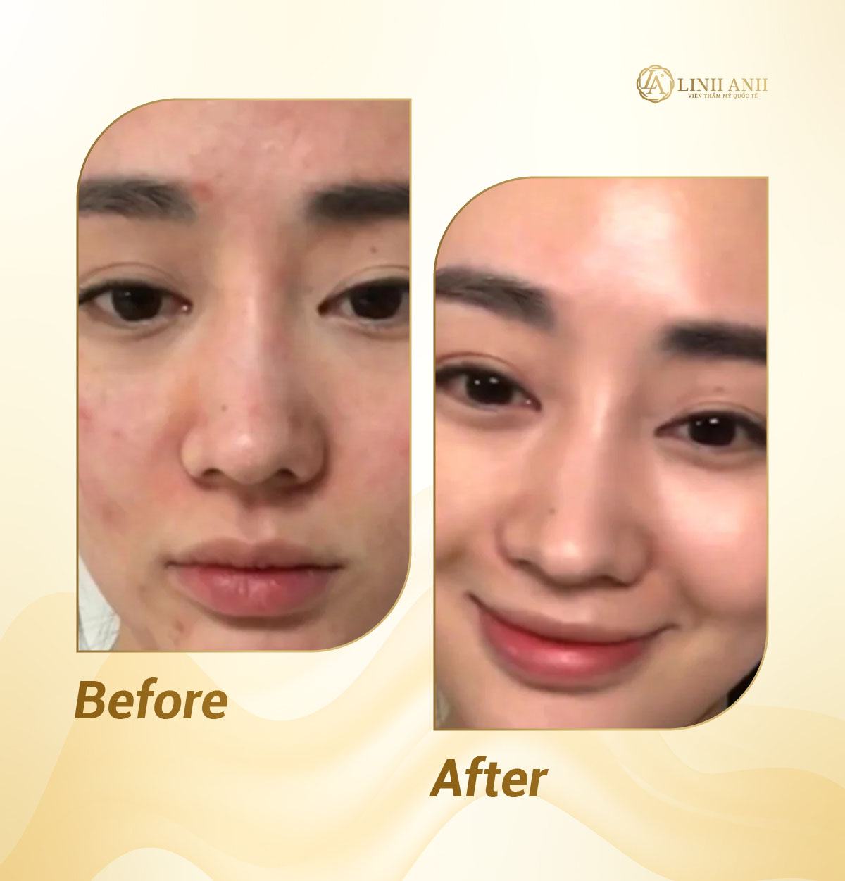 cách trị mụn cho bà bầu hiệu quả cách trị mụn cho bà bầu hiệu quả - Viện thẩm mỹ quốc tế Linh Anh