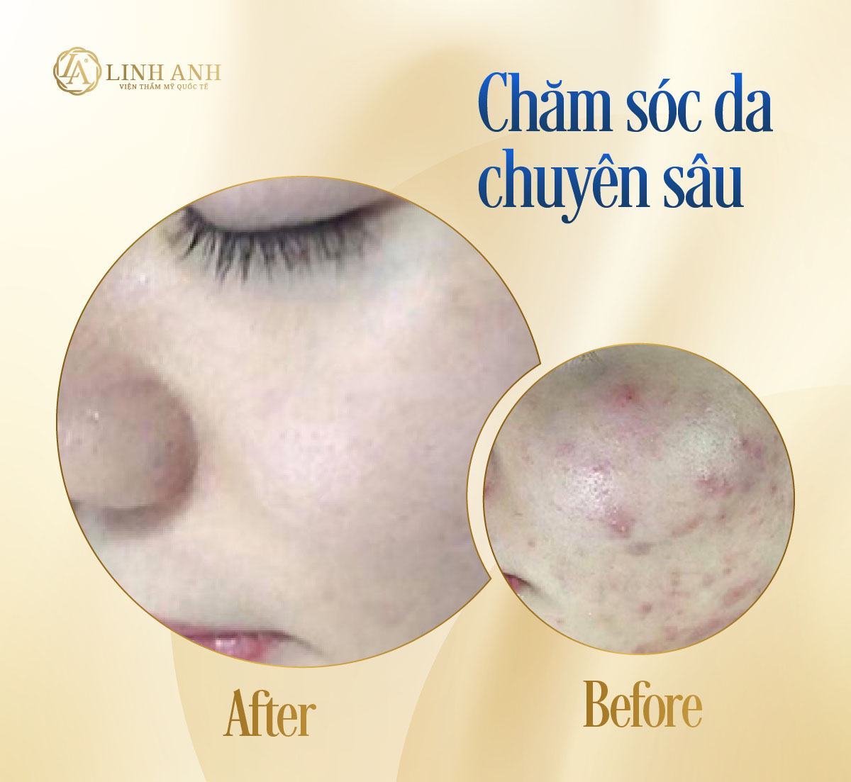vasaline trị mụn đầu đen cách trị mụn đầu đen với vaseline - Viện thẩm mỹ quốc tế Linh Anh