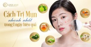 cách trị mụn tại nhà - Viện thẩm mỹ quốc tế Linh Anh