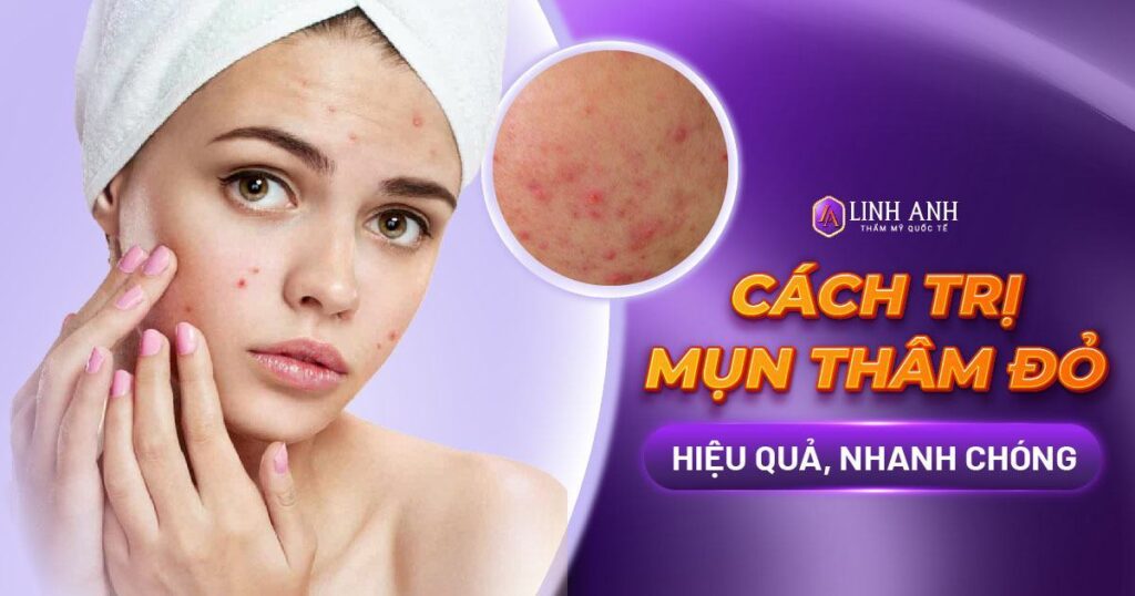 cách trị mụn thâm đỏ
