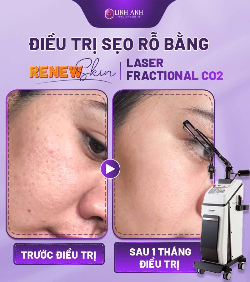 cách trị sẹo rỗ trên mặt cách trị mụn thâm sẹo rỗ tại nhà