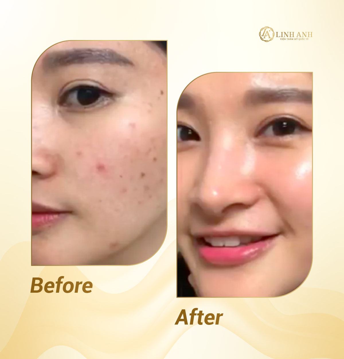 bí kíp trị mụn cho bà bầu cách trị mụn trứng cá cho bà bầu - Viện thẩm mỹ quốc tế Linh Anh