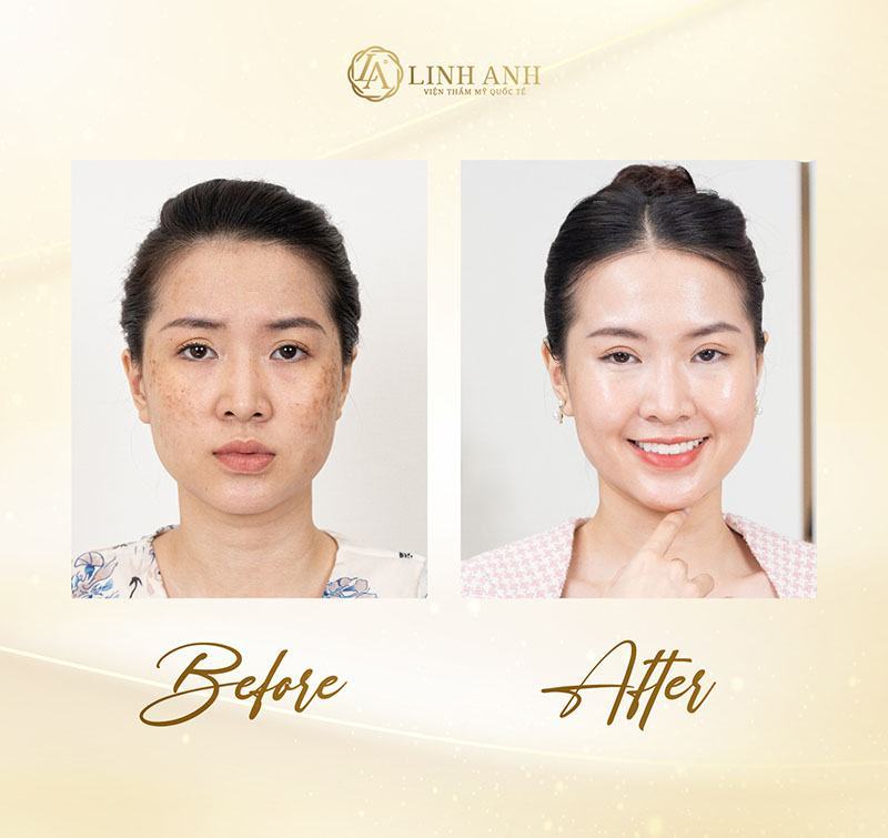 cách làm lá trầu trị nám cách trị nám bằng lá trầu không tại nhà - Viện thẩm mỹ quốc tế Linh Anh