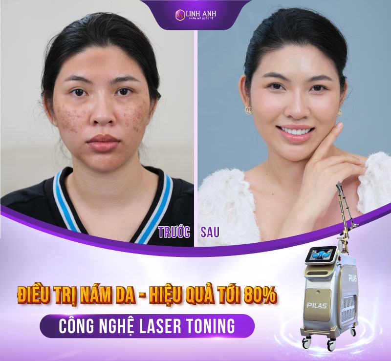 trị nám bằng rau diếp cá cách trị nám bằng rau diếp cá hiệu quả