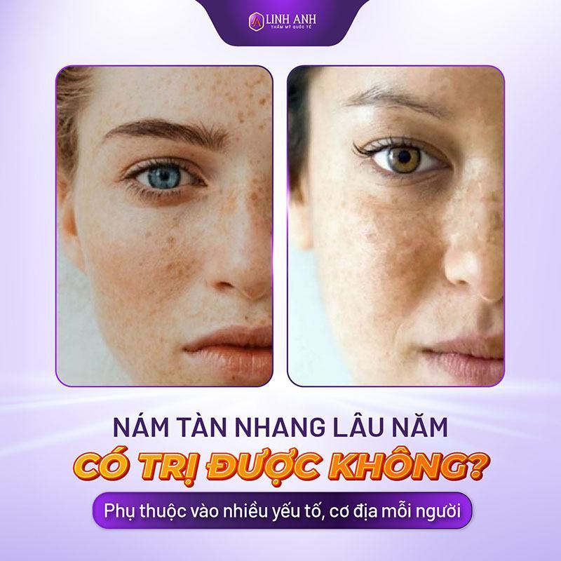 cách trị nám tàn nhang lâu năm cách trị nám da mặt lâu năm