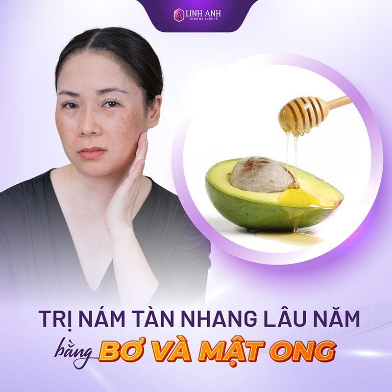 cách trị nám cách trị nám tàn nhang lâu năm bằng bơ và mật ong