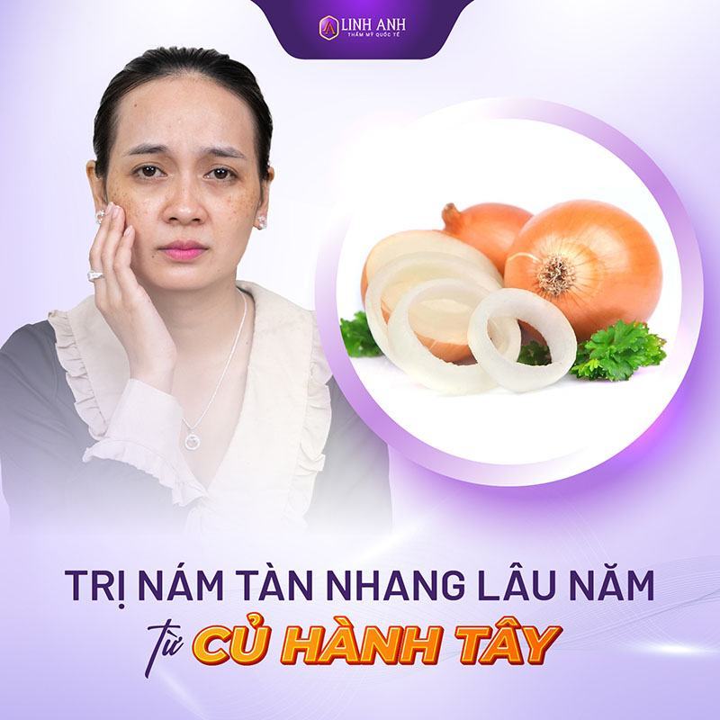 cách trị nám da lâu năm cách trị nám tàn nhang lâu năm bằng củ hành tây
